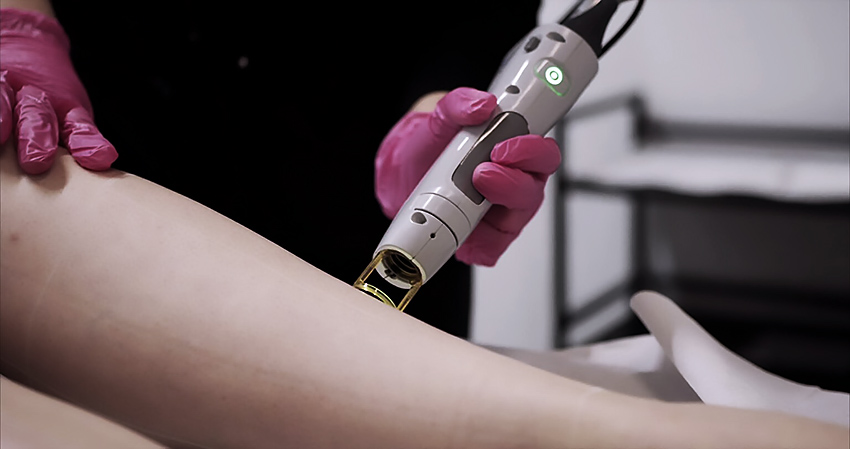 Лазерная эпиляция: эстетика и безопасность